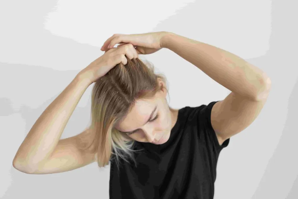 dermatitis-seboroik-pada-rambut-penyebab-dan-perawatan-efektif