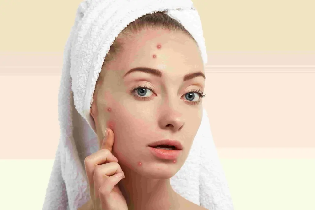 treatment-acne-facial-di-lavalen