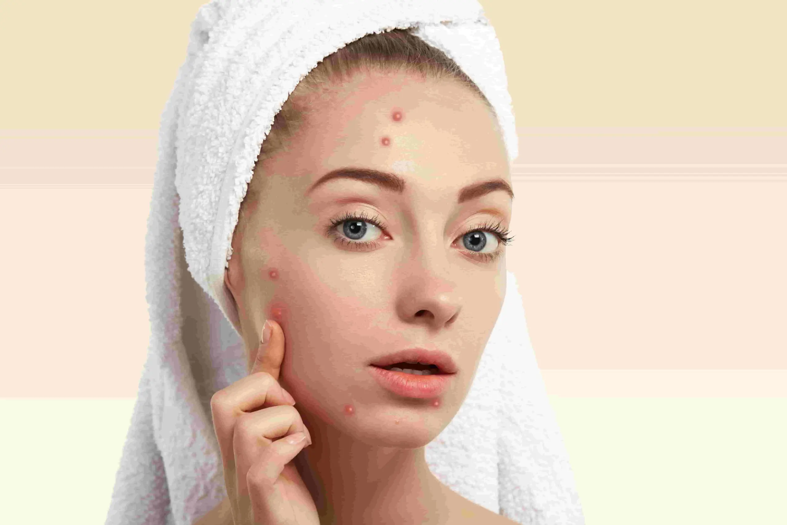 treatment-acne-facial-di-lavalen