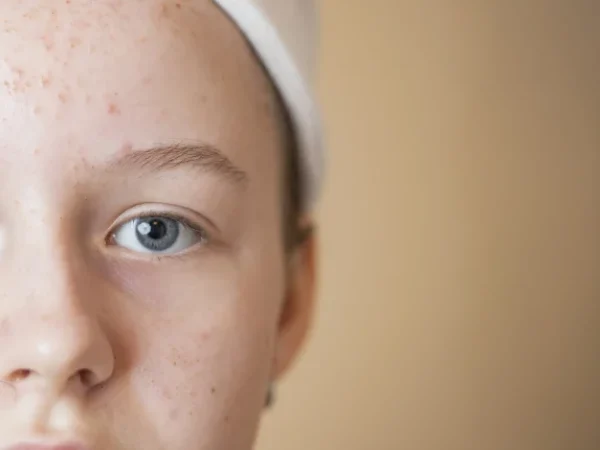 Bopeng bekas jerawat