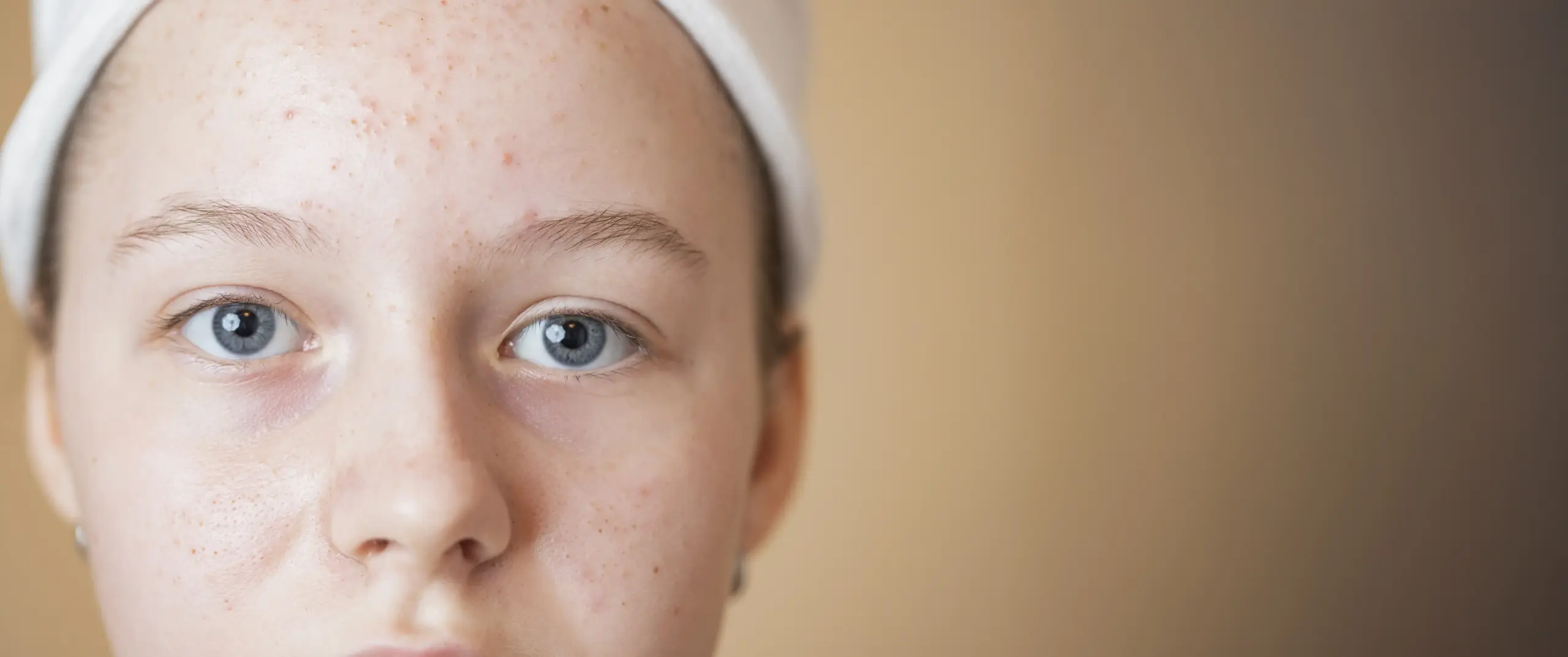 Bopeng Bekas Jerawat