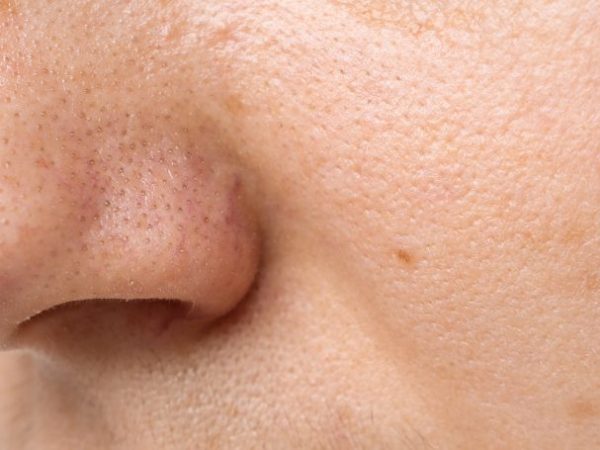 mengecilkan pori pori Lavalen Beauty