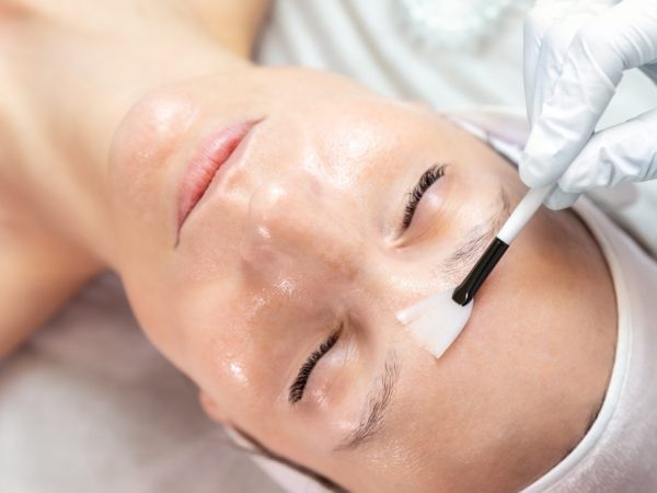 chemical peeling klinik lavalen beauty
