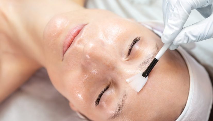 chemical peeling klinik lavalen beauty