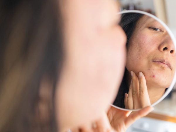 perawatan jerawat di klinik lavalen beauty