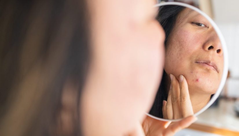 perawatan jerawat di klinik lavalen beauty