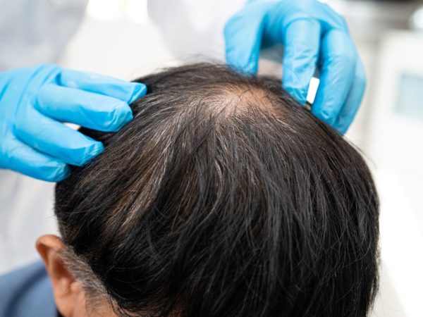 PRP rambut lavalen beauty