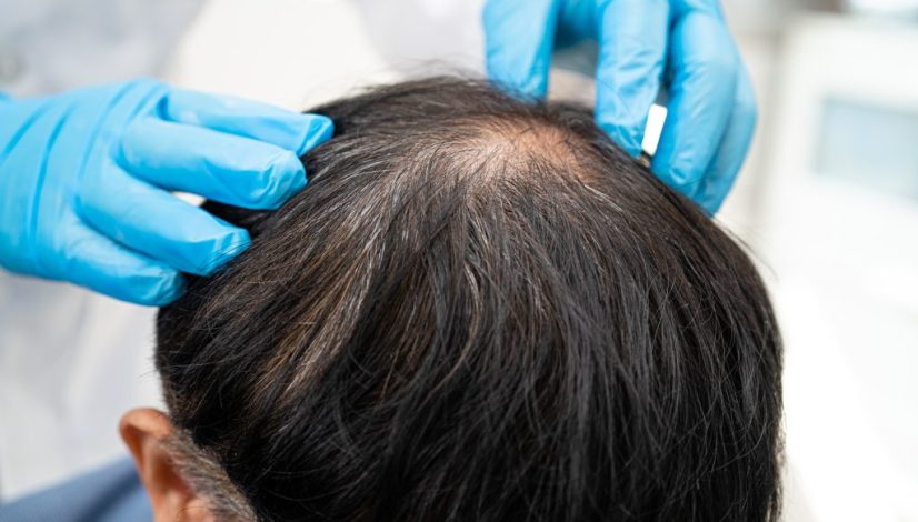 PRP rambut lavalen beauty