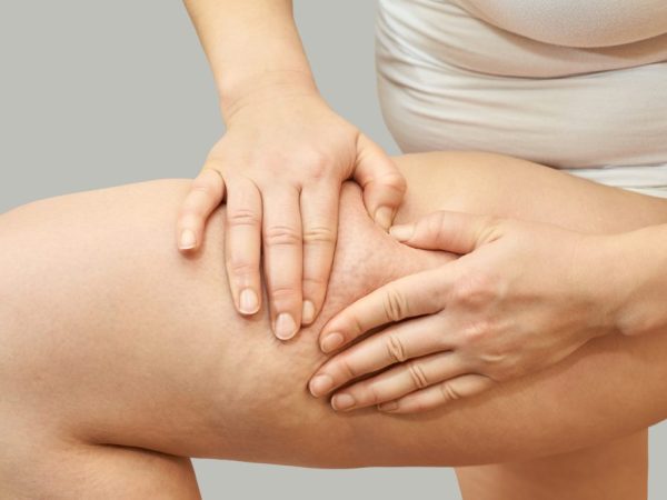 seorang wanita yang menunjukan selulit untuk dapat bisa treatment selulit