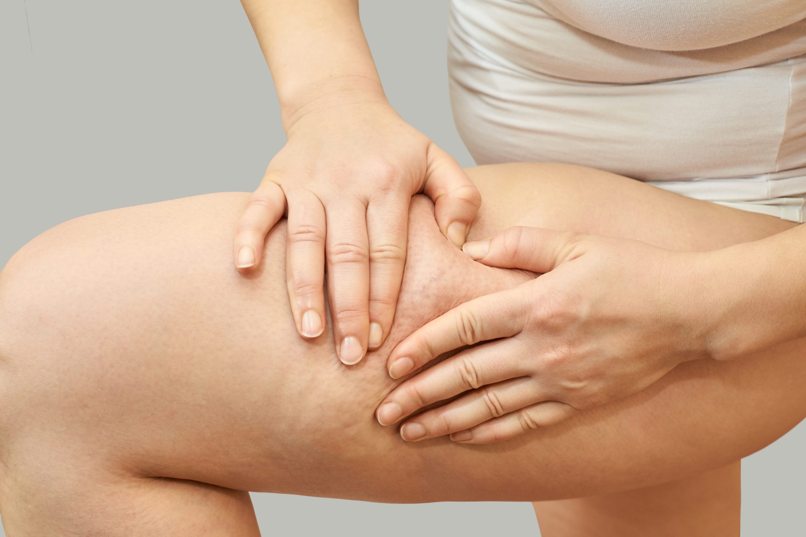 seorang wanita yang menunjukan selulit untuk dapat bisa treatment selulit