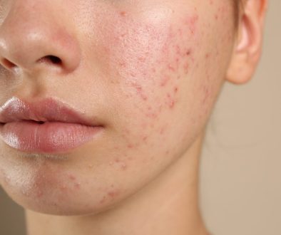 penanganan jerawat membandel di lavalen beauty