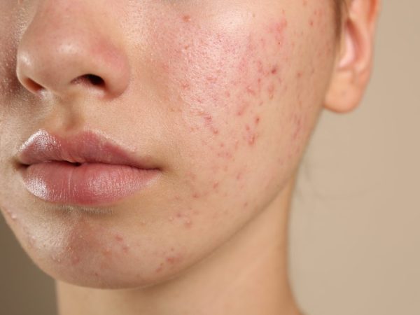 penanganan jerawat membandel di lavalen beauty