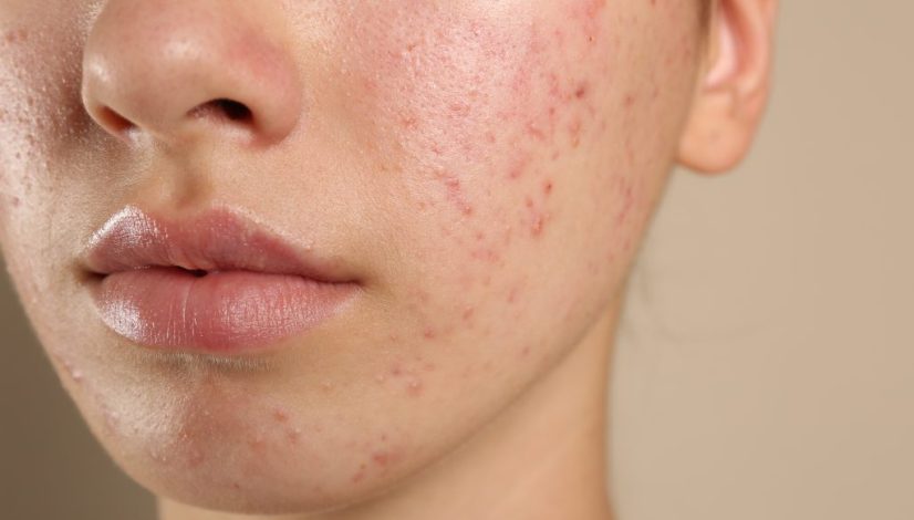 penanganan jerawat membandel di lavalen beauty