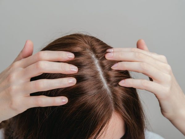 cara menghilangkan ketombe di lavalen beauty