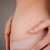 cara menghilangkan stretch mark