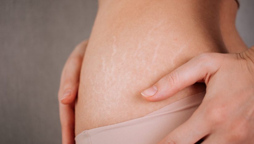 cara menghilangkan stretch mark