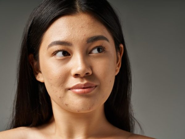 cara mengatasi kulit berminyak di lavalen beauty