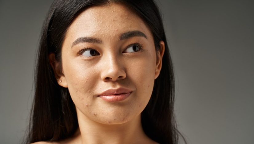 cara mengatasi kulit berminyak di lavalen beauty