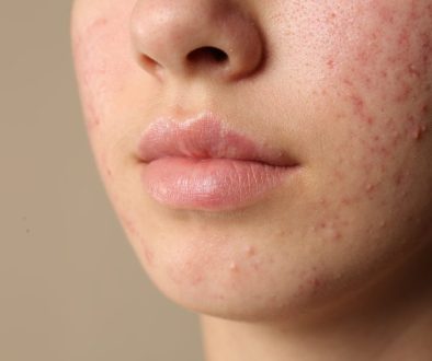 cara menghilangkan bruntusan di lavalen beauty