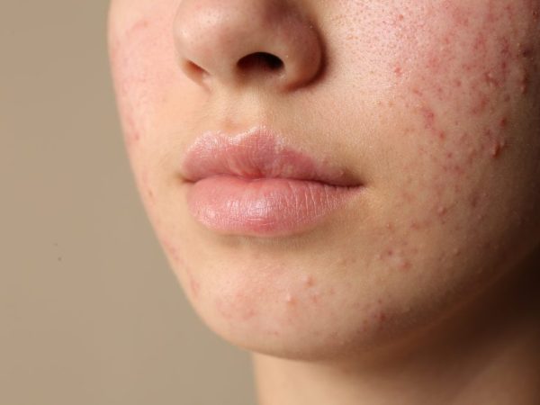 cara menghilangkan bruntusan di lavalen beauty