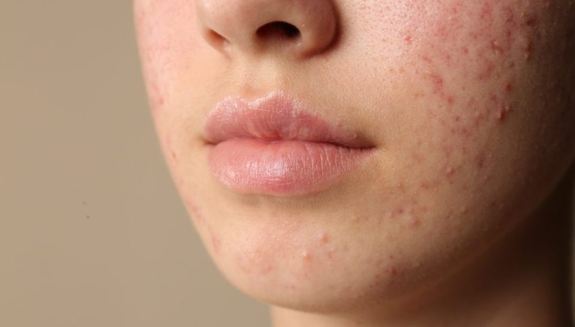 cara menghilangkan bruntusan di lavalen beauty