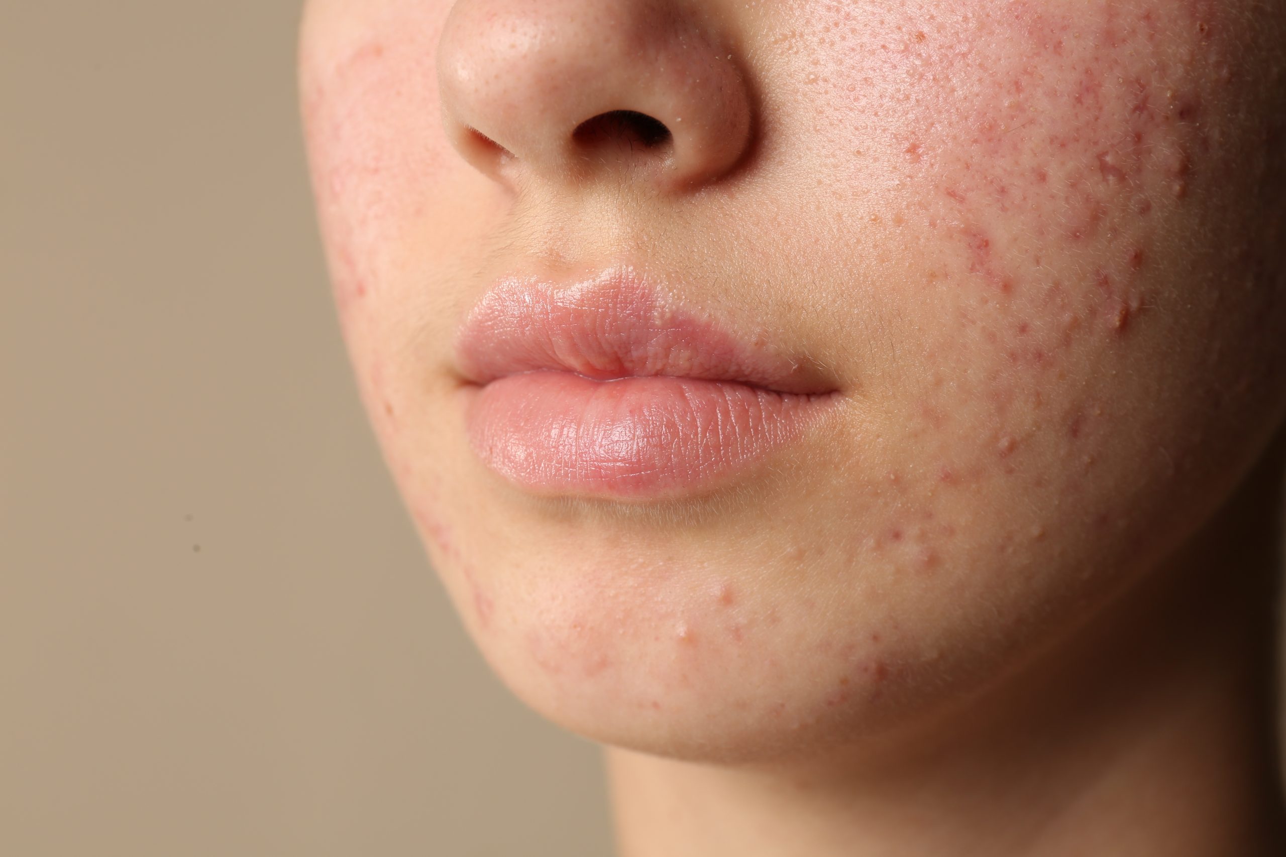 cara menghilangkan bruntusan di lavalen beauty