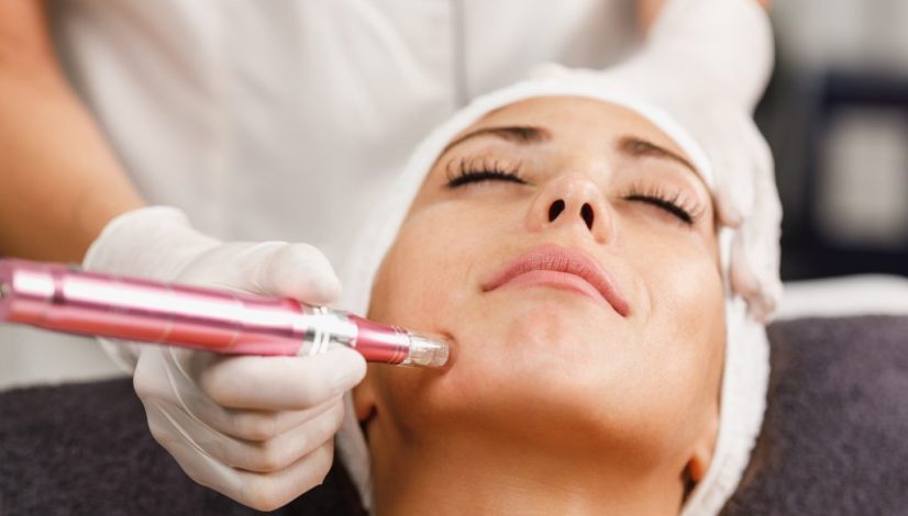 treatment microneedling di lavalen beauty