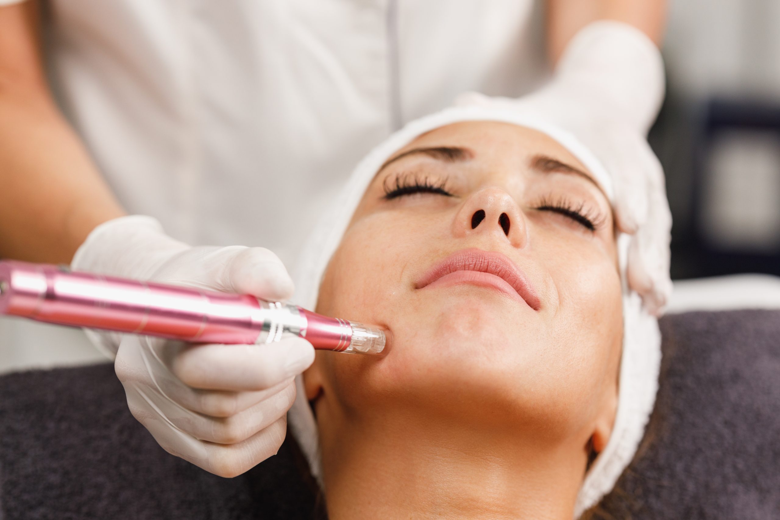 treatment microneedling di lavalen beauty