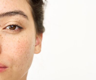 dark spot vs melasma bedanya