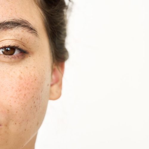 dark spot vs melasma bedanya