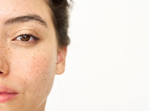 dark spot vs melasma bedanya