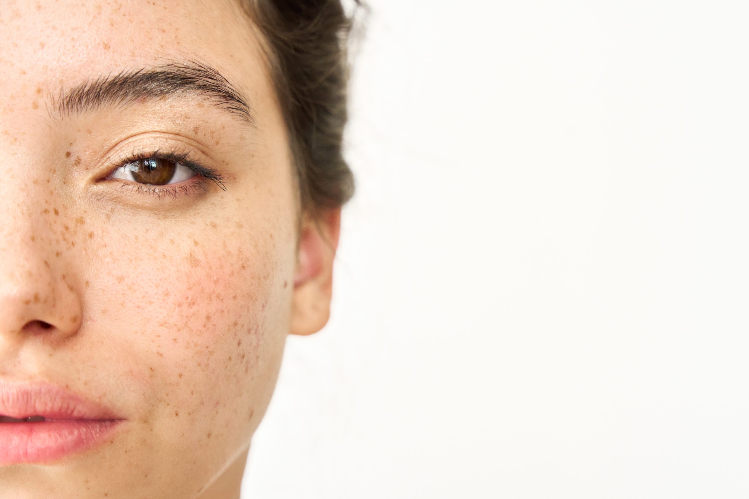 dark spot vs melasma bedanya