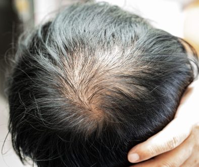 rambut rontok musim kemarau
