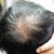 rambut rontok musim kemarau