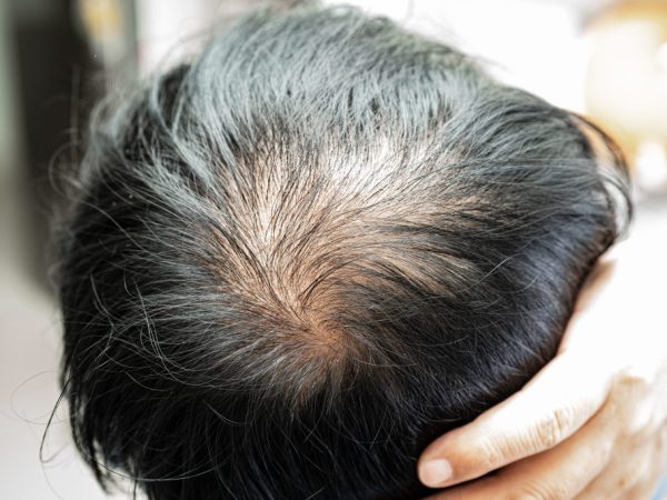 rambut rontok musim kemarau