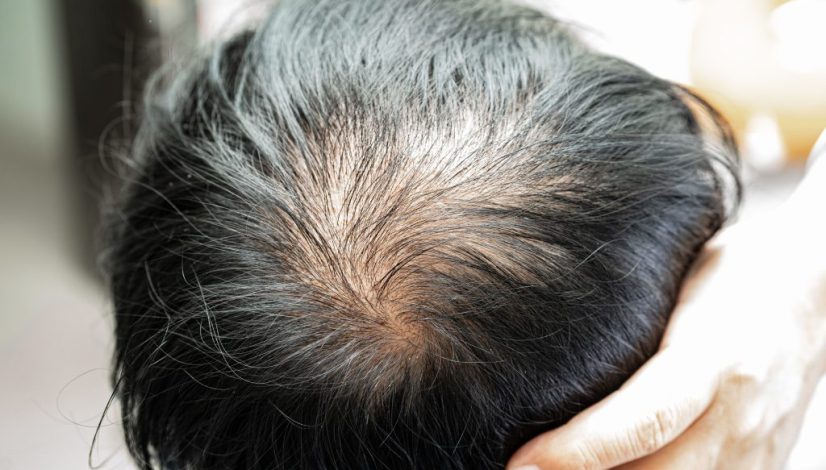rambut rontok musim kemarau