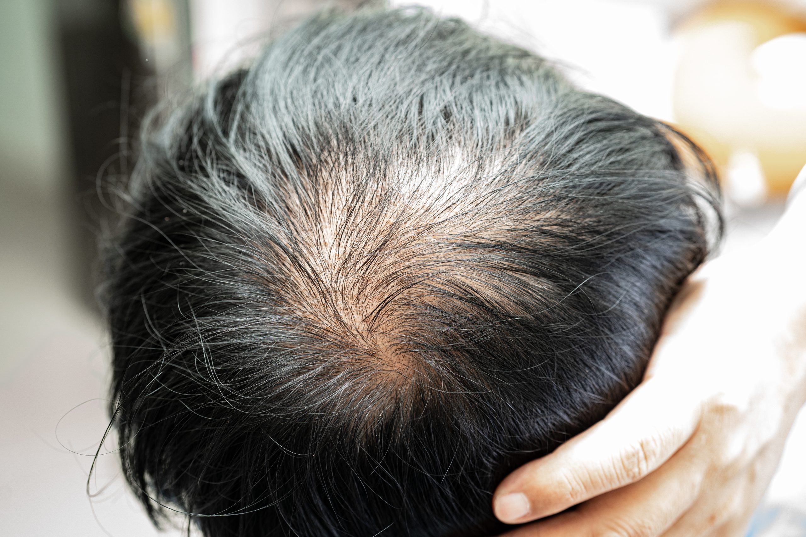 rambut rontok musim kemarau
