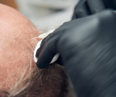 transplant rambut vs stem cell
