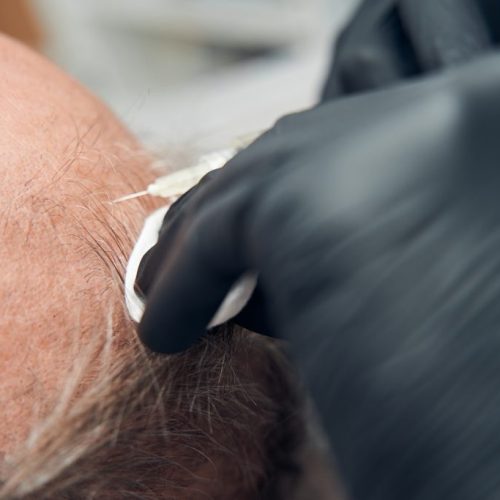 transplant rambut vs stem cell