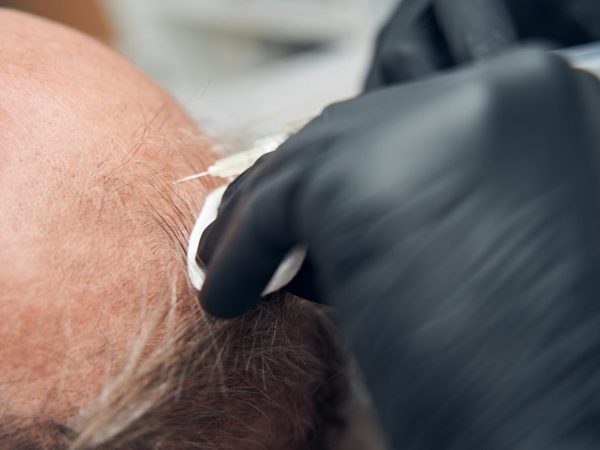 transplant rambut vs stem cell