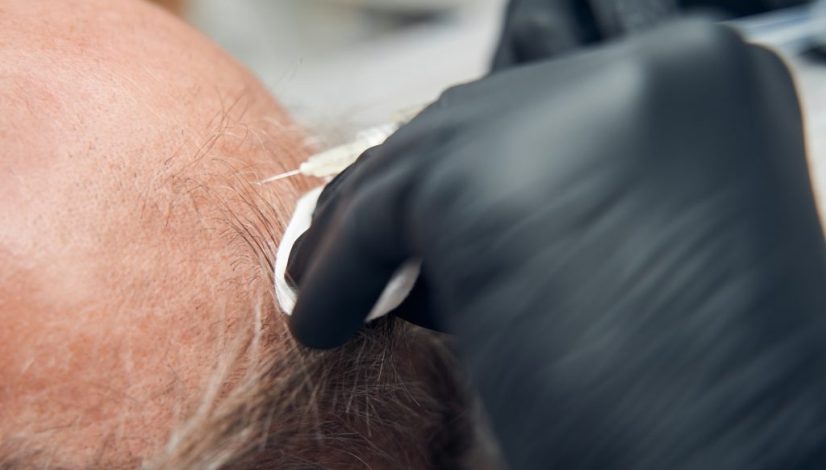 transplant rambut vs stem cell