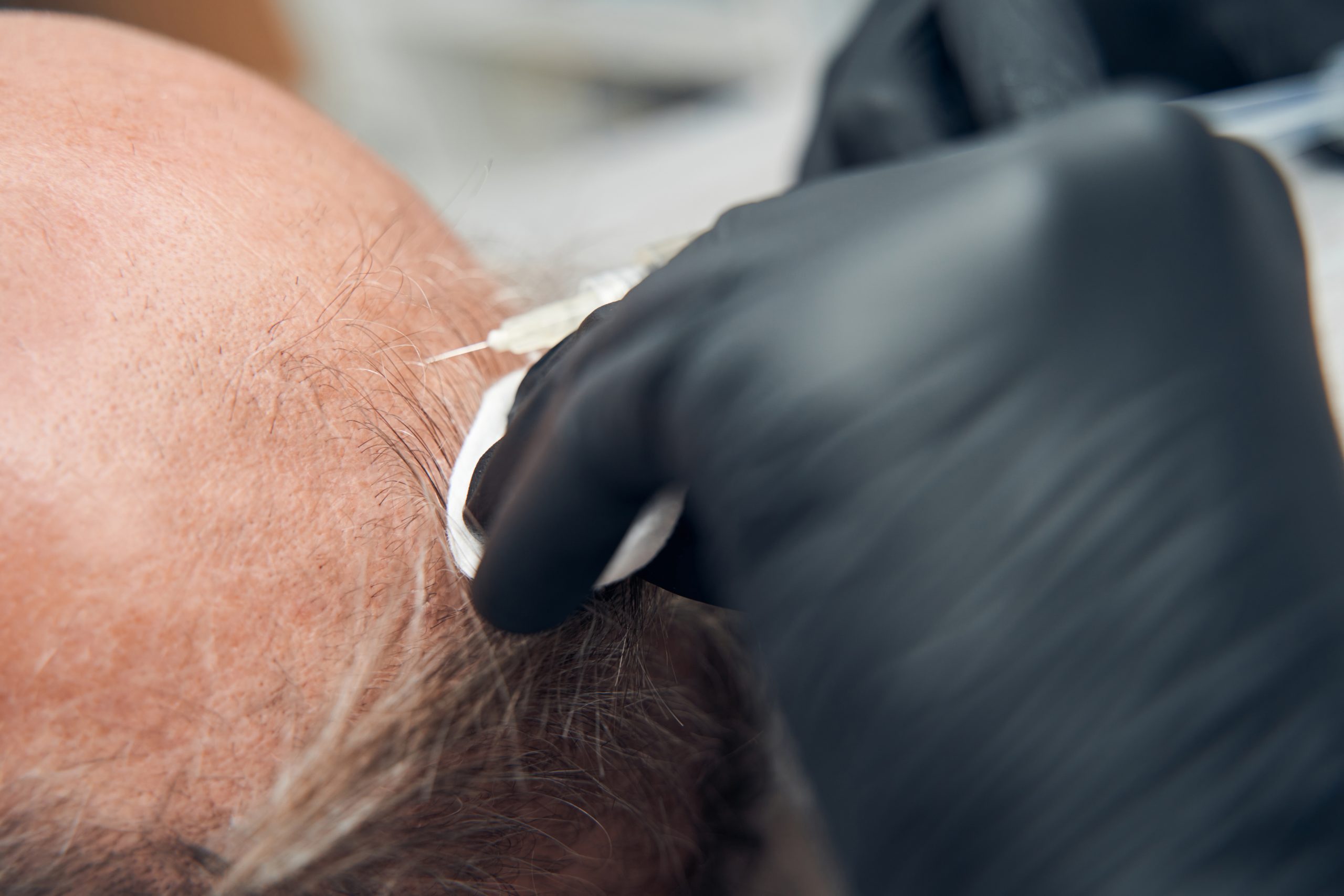 transplant rambut vs stem cell